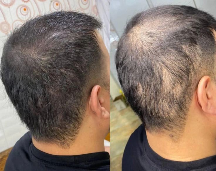 RoSaCaPiL: Huile AntiChute Premium 5en1